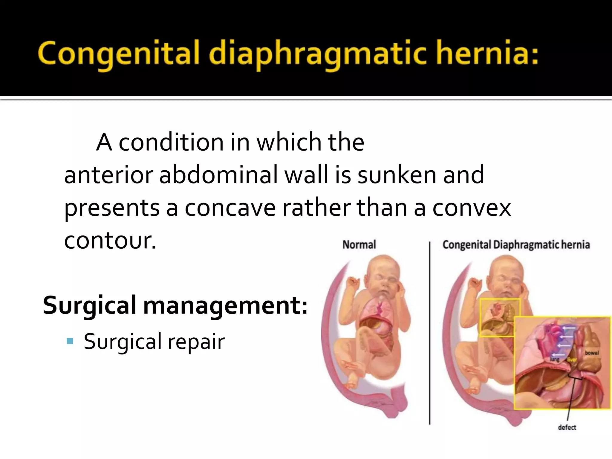 A condition in which the
anterior abdominal wall is sunken and
presents a concave rather than a convex
contour.
Surgical management:
 Surgical repair
 