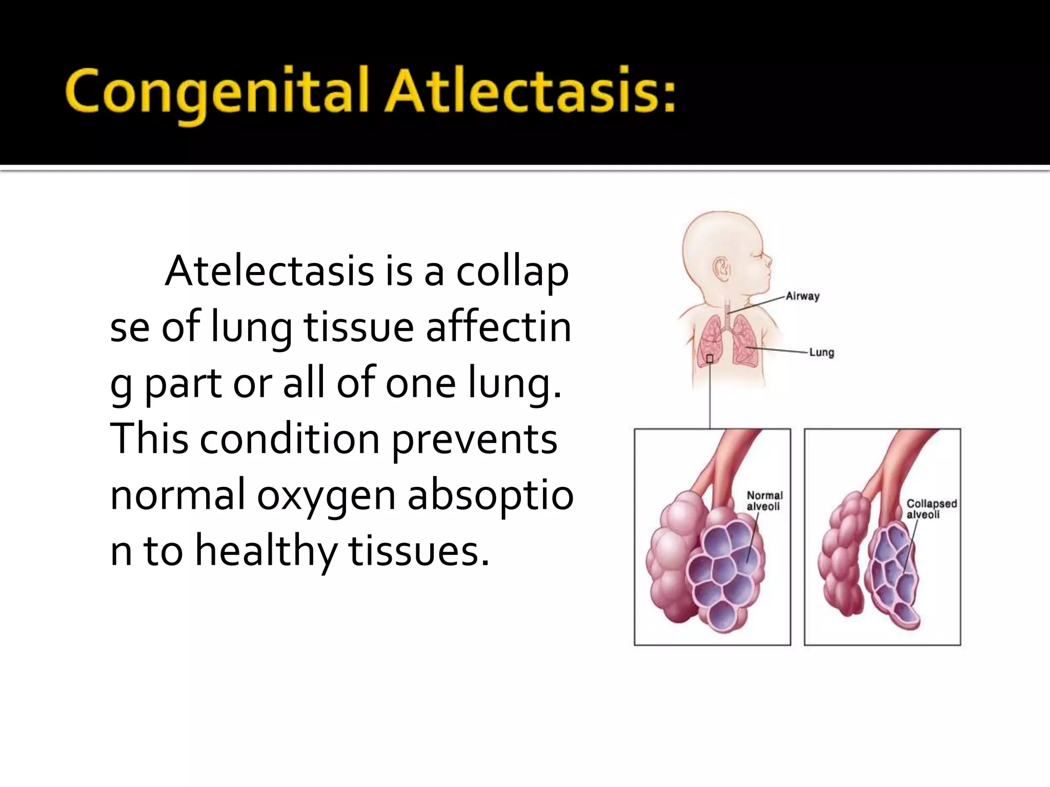Atelectasis is a collap
se of lung tissue affectin
g part or all of one lung.
This condition prevents
normal oxygen absoptio
n to healthy tissues.
 