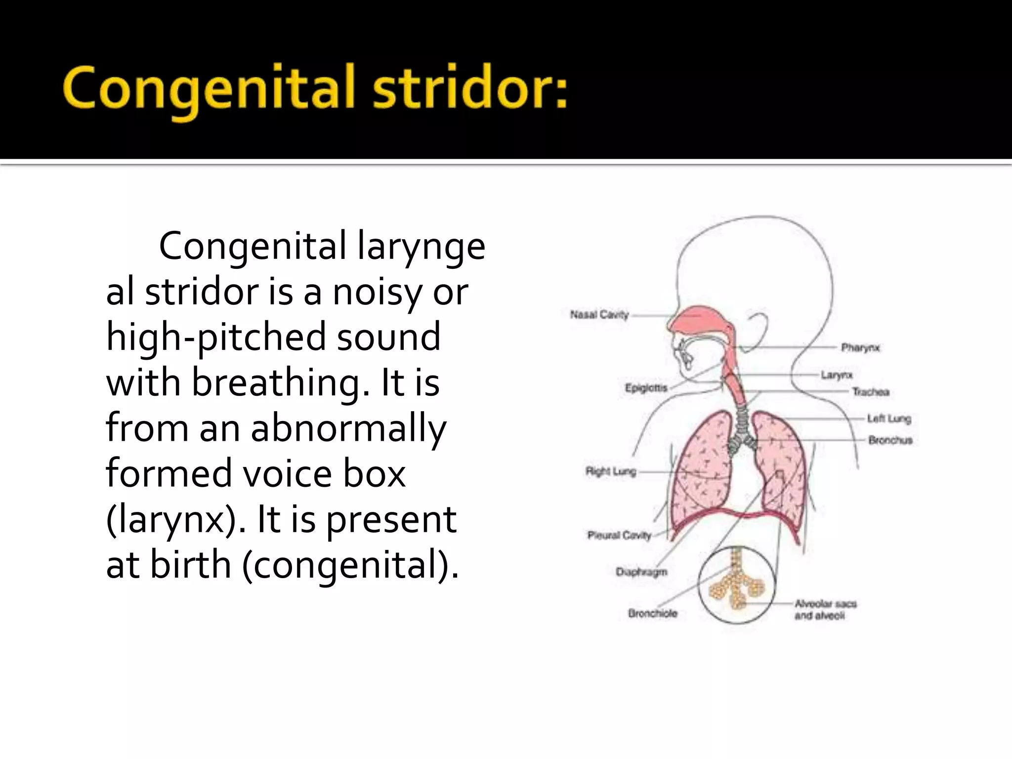Congenital larynge
al stridor is a noisy or
high-pitched sound
with breathing. It is
from an abnormally
formed voice box
(larynx). It is present
at birth (congenital).
 