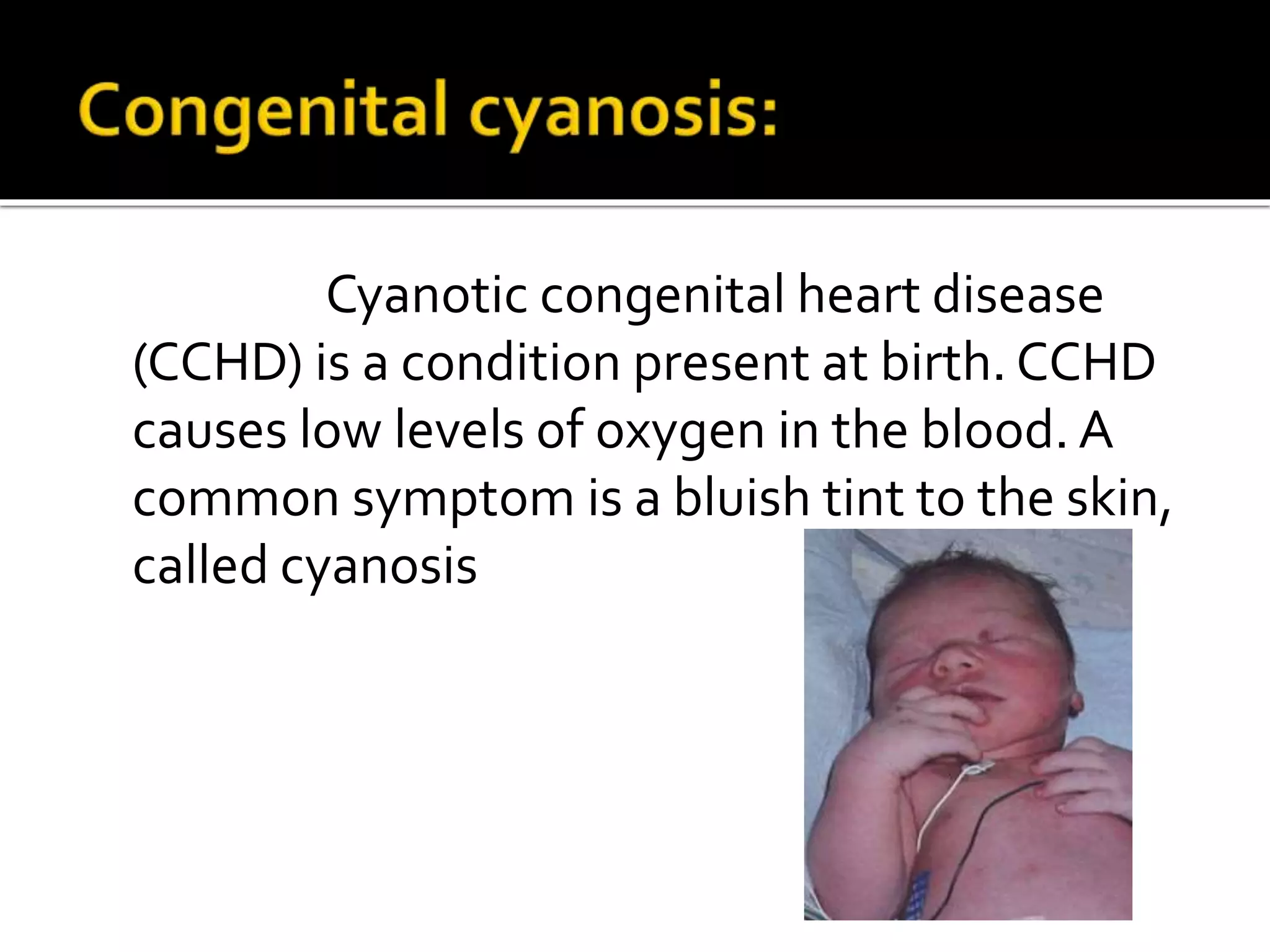 Cyanotic congenital heart disease
(CCHD) is a condition present at birth. CCHD
causes low levels of oxygen in the blood. A
common symptom is a bluish tint to the skin,
called cyanosis
 