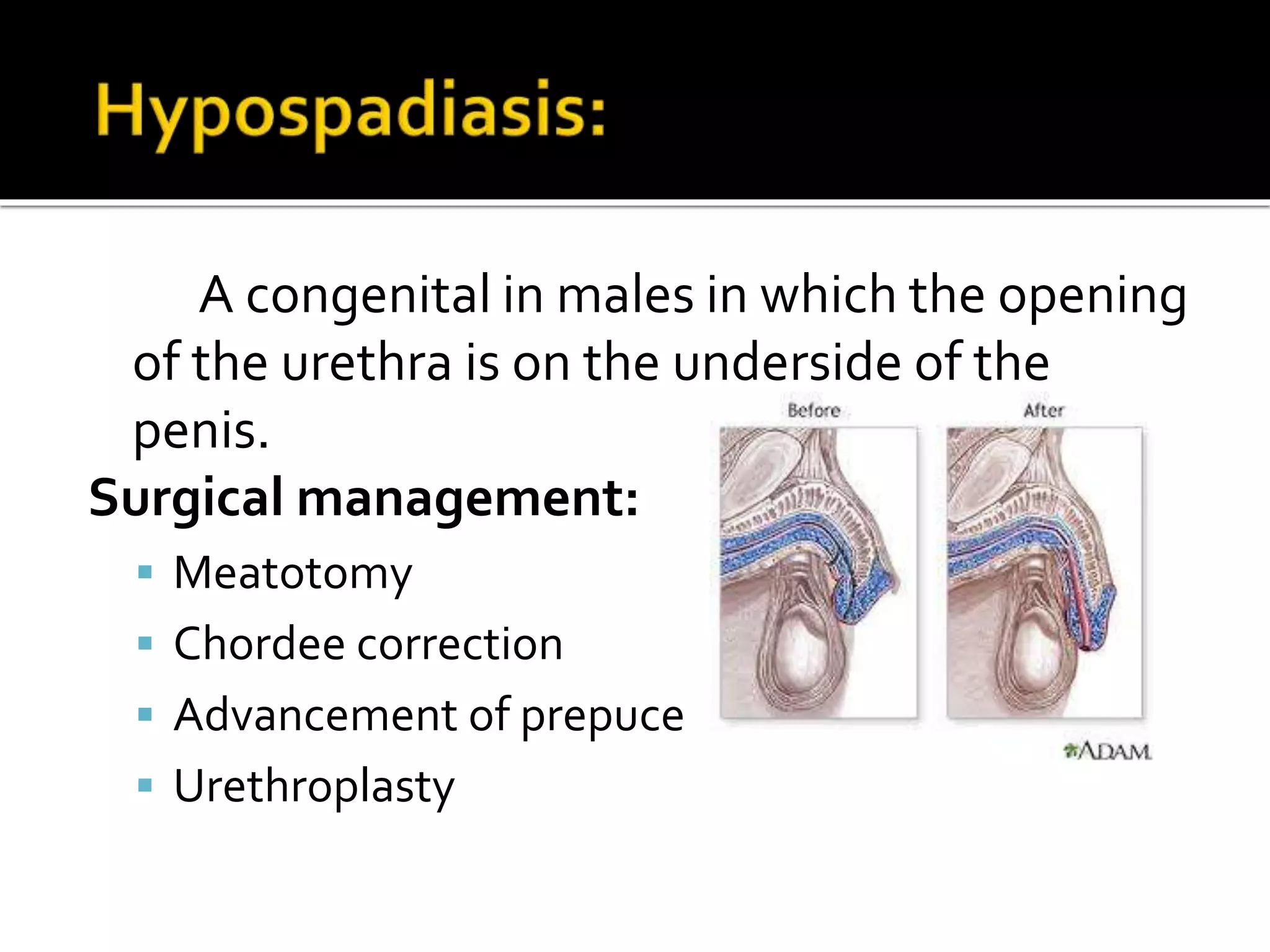 A congenital in males in which the opening
of the urethra is on the underside of the
penis.
Surgical management:
 Meatotomy
 Chordee correction
 Advancement of prepuce
 Urethroplasty
 
