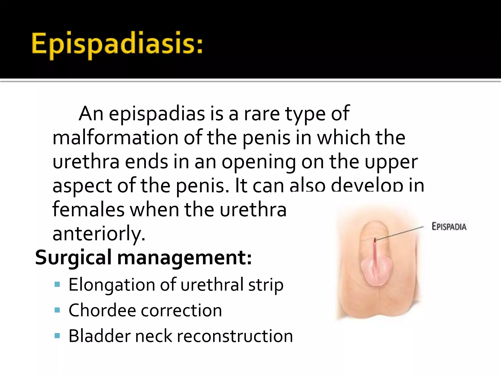 An epispadias is a rare type of
malformation of the penis in which the
urethra ends in an opening on the upper
aspect of the penis. It can also develop in
females when the urethra develops too far
anteriorly.
Surgical management:
 Elongation of urethral strip
 Chordee correction
 Bladder neck reconstruction
 