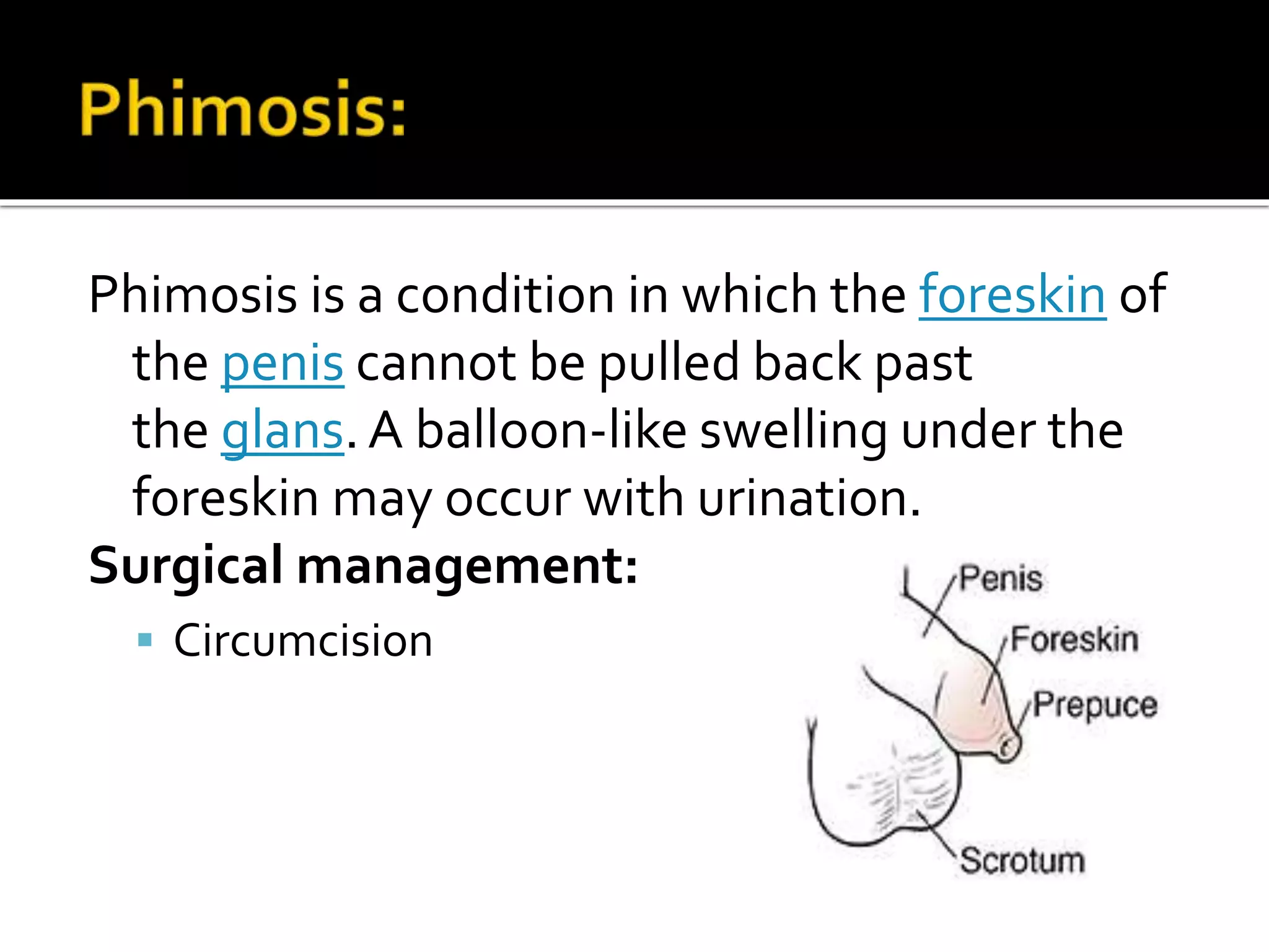 Phimosis is a condition in which the foreskin of
the penis cannot be pulled back past
the glans.A balloon-like swelling under the
foreskin may occur with urination.
Surgical management:
 Circumcision
 