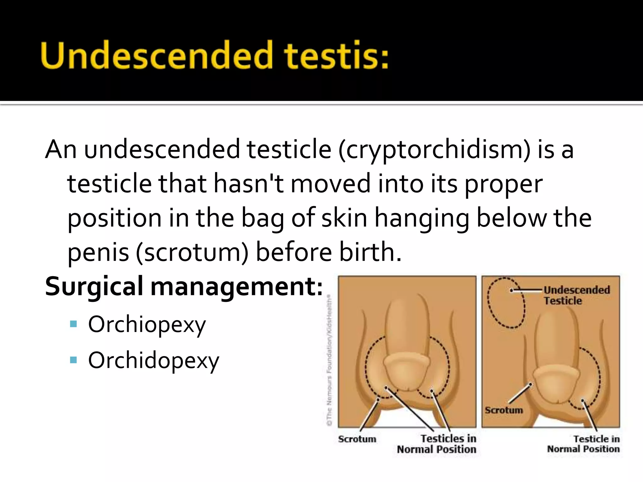 An undescended testicle (cryptorchidism) is a
testicle that hasn't moved into its proper
position in the bag of skin hanging below the
penis (scrotum) before birth.
Surgical management:
 Orchiopexy
 Orchidopexy
 