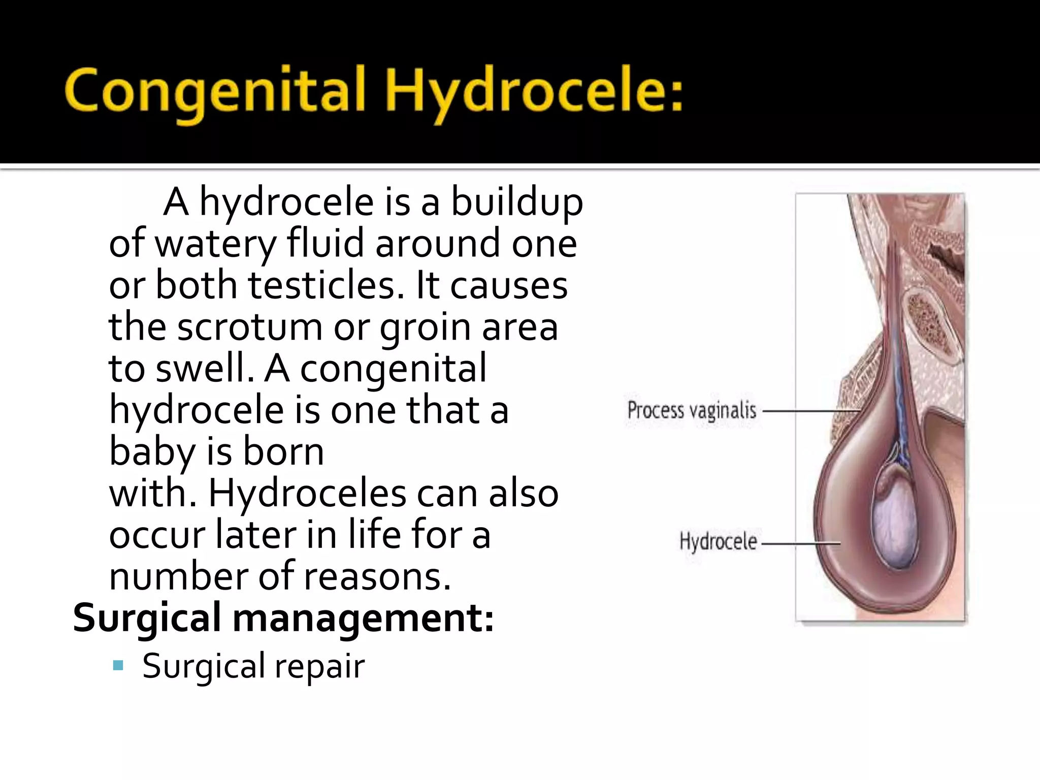 A hydrocele is a buildup
of watery fluid around one
or both testicles. It causes
the scrotum or groin area
to swell. A congenital
hydrocele is one that a
baby is born
with. Hydroceles can also
occur later in life for a
number of reasons.
Surgical management:
 Surgical repair
 
