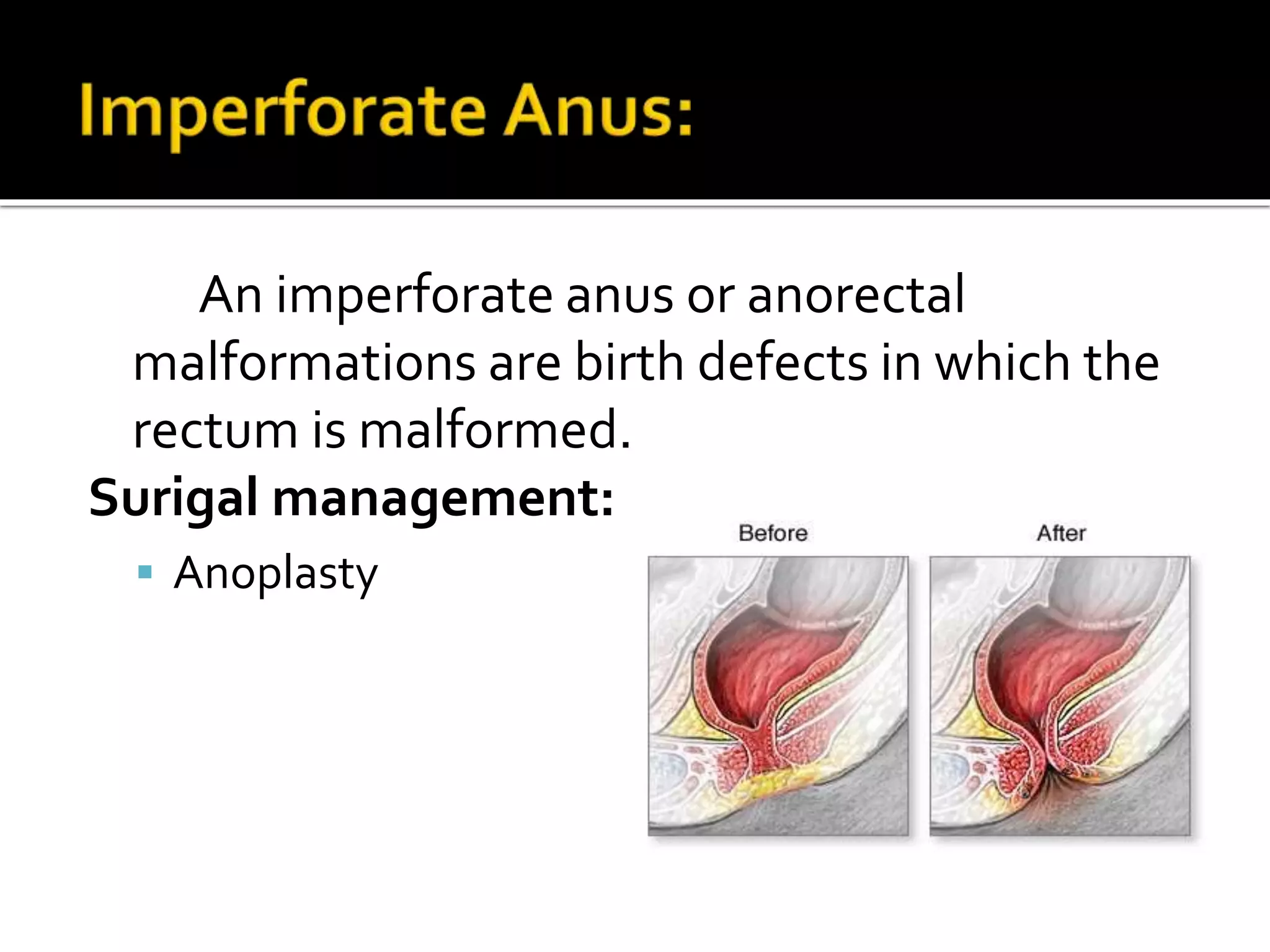 An imperforate anus or anorectal
malformations are birth defects in which the
rectum is malformed.
Surigal management:
 Anoplasty
 