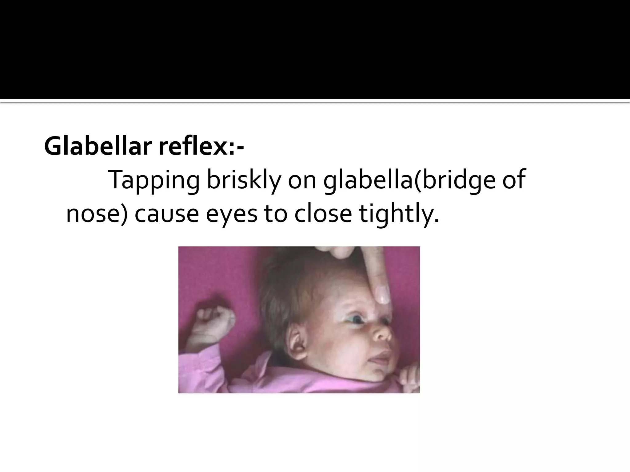 Glabellar reflex:-
Tapping briskly on glabella(bridge of
nose) cause eyes to close tightly.
 