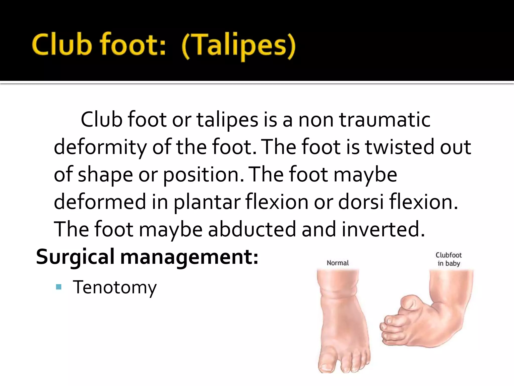 Club foot or talipes is a non traumatic
deformity of the foot.The foot is twisted out
of shape or position.The foot maybe
deformed in plantar flexion or dorsi flexion.
The foot maybe abducted and inverted.
Surgical management:
 Tenotomy
 