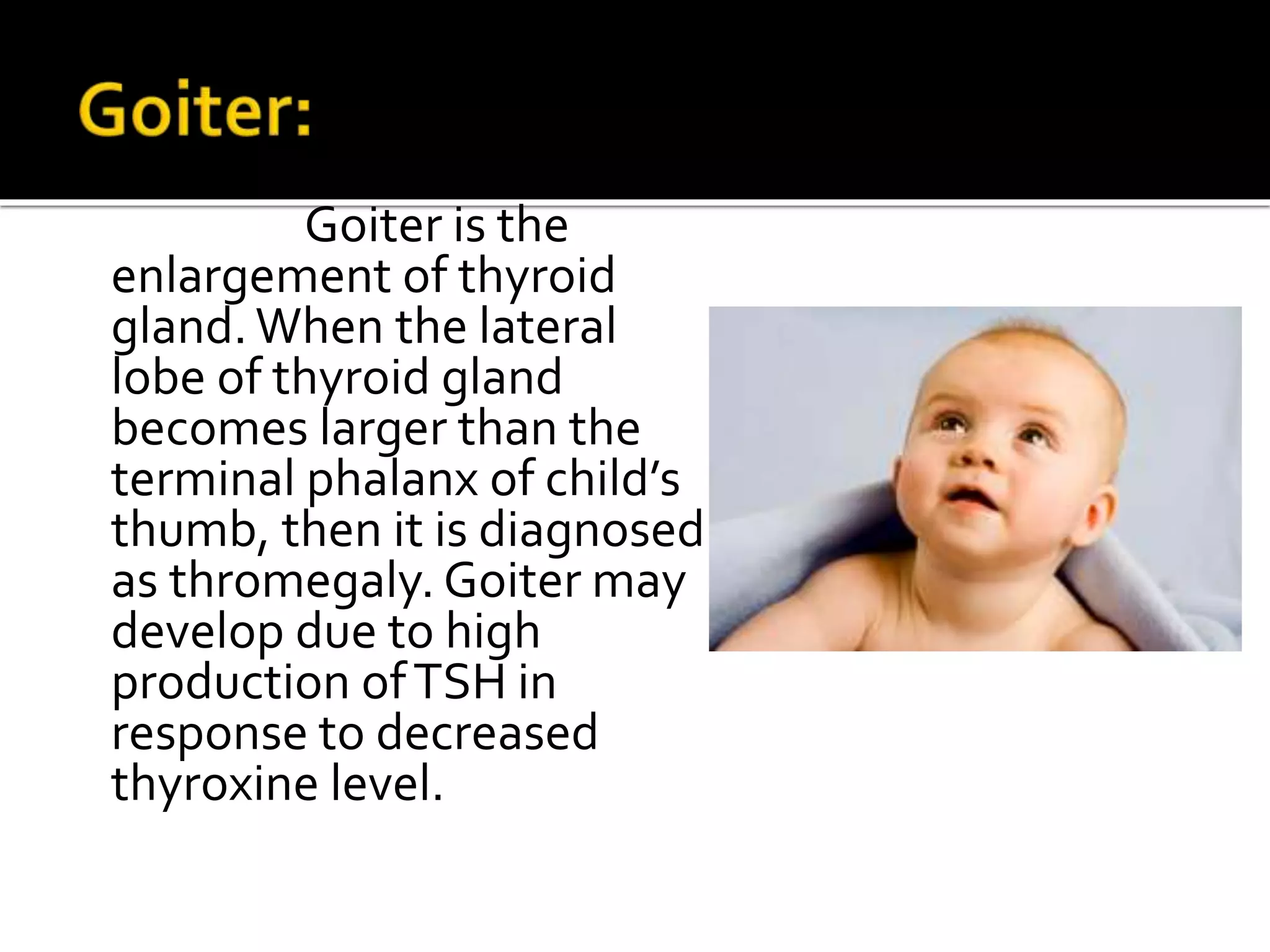 Goiter is the
enlargement of thyroid
gland.When the lateral
lobe of thyroid gland
becomes larger than the
terminal phalanx of child’s
thumb, then it is diagnosed
as thromegaly. Goiter may
develop due to high
production ofTSH in
response to decreased
thyroxine level.
 