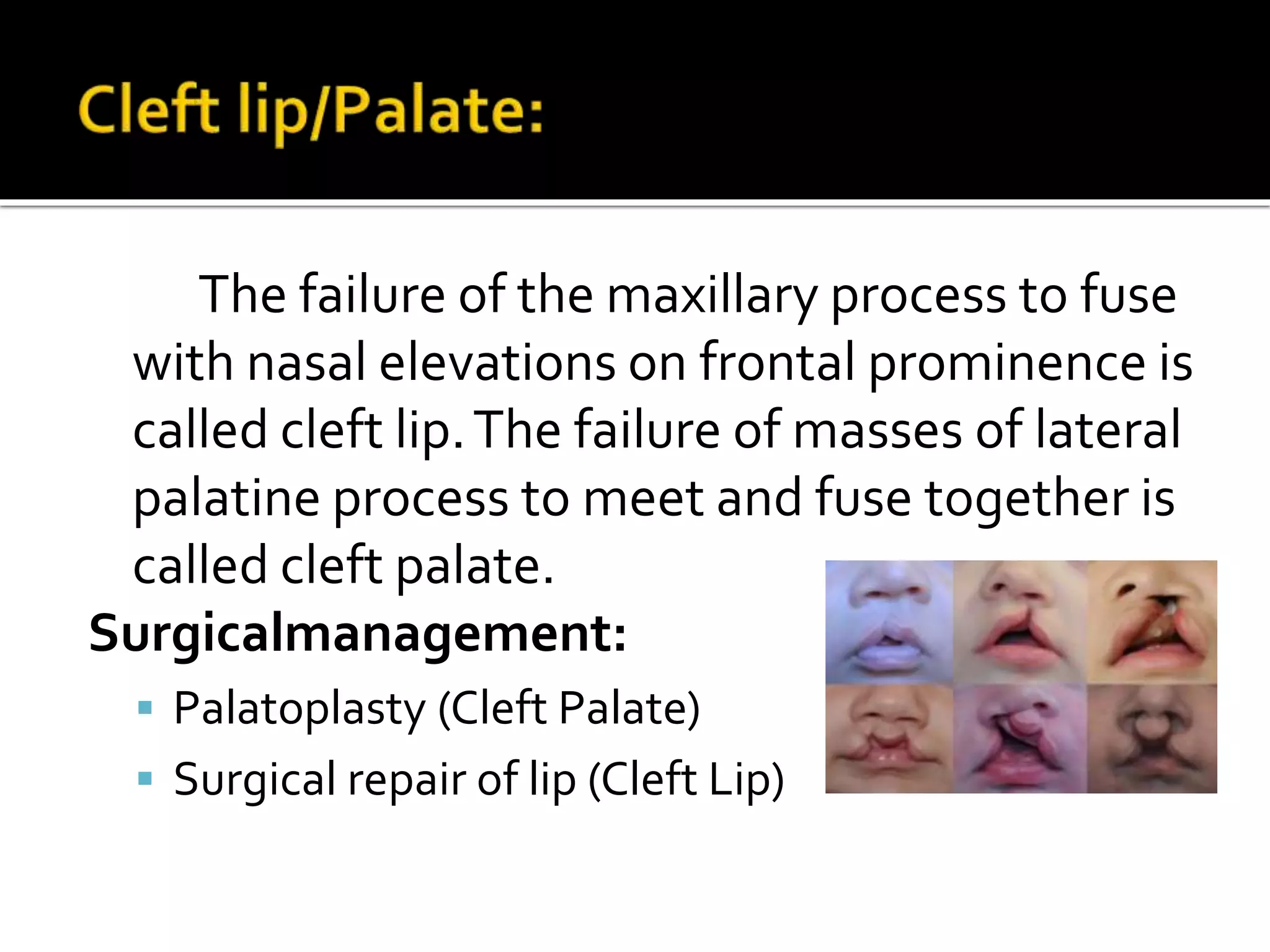 The failure of the maxillary process to fuse
with nasal elevations on frontal prominence is
called cleft lip.The failure of masses of lateral
palatine process to meet and fuse together is
called cleft palate.
Surgicalmanagement:
 Palatoplasty (Cleft Palate)
 Surgical repair of lip (Cleft Lip)
 