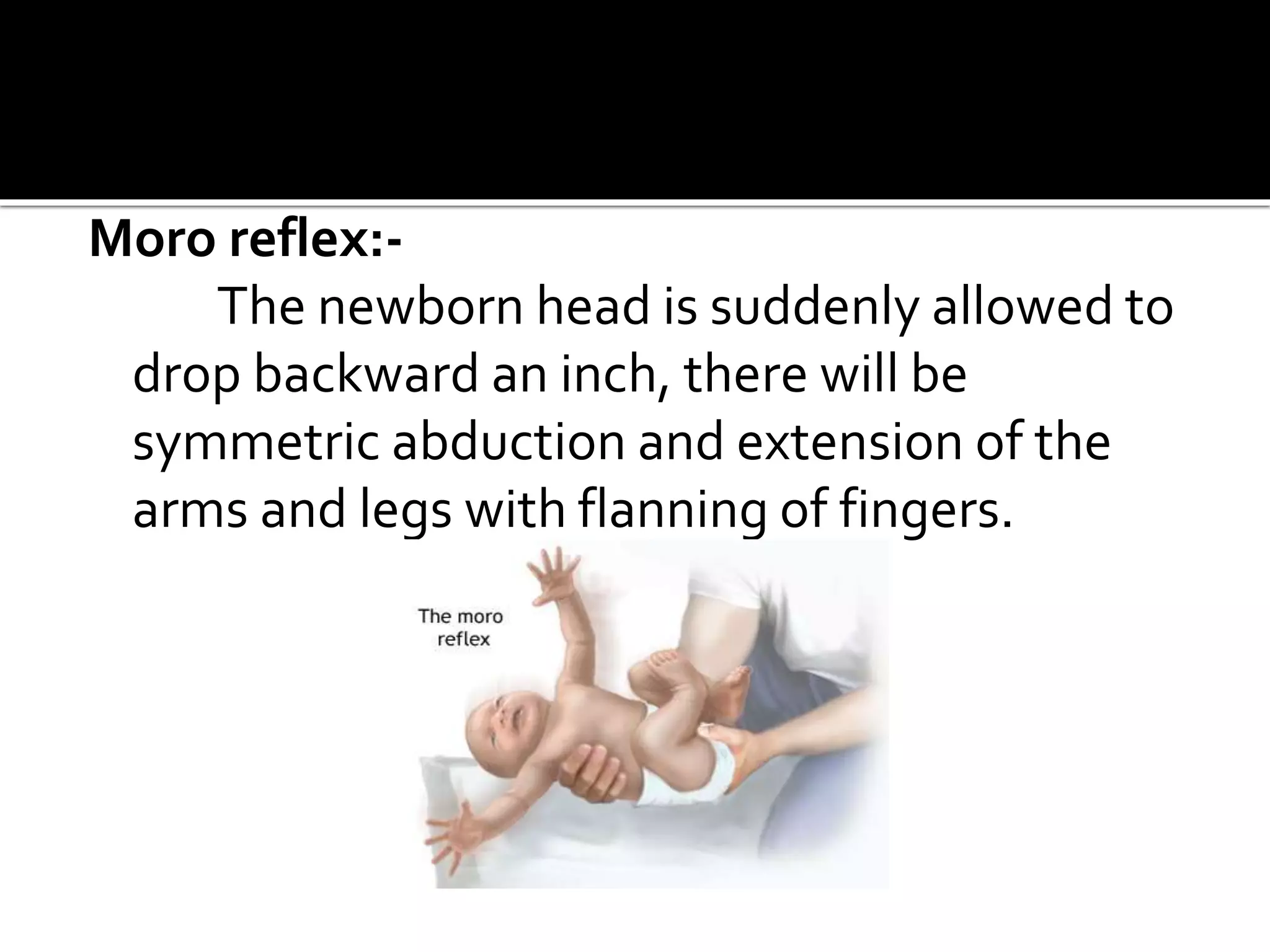 Moro reflex:-
The newborn head is suddenly allowed to
drop backward an inch, there will be
symmetric abduction and extension of the
arms and legs with flanning of fingers.
 