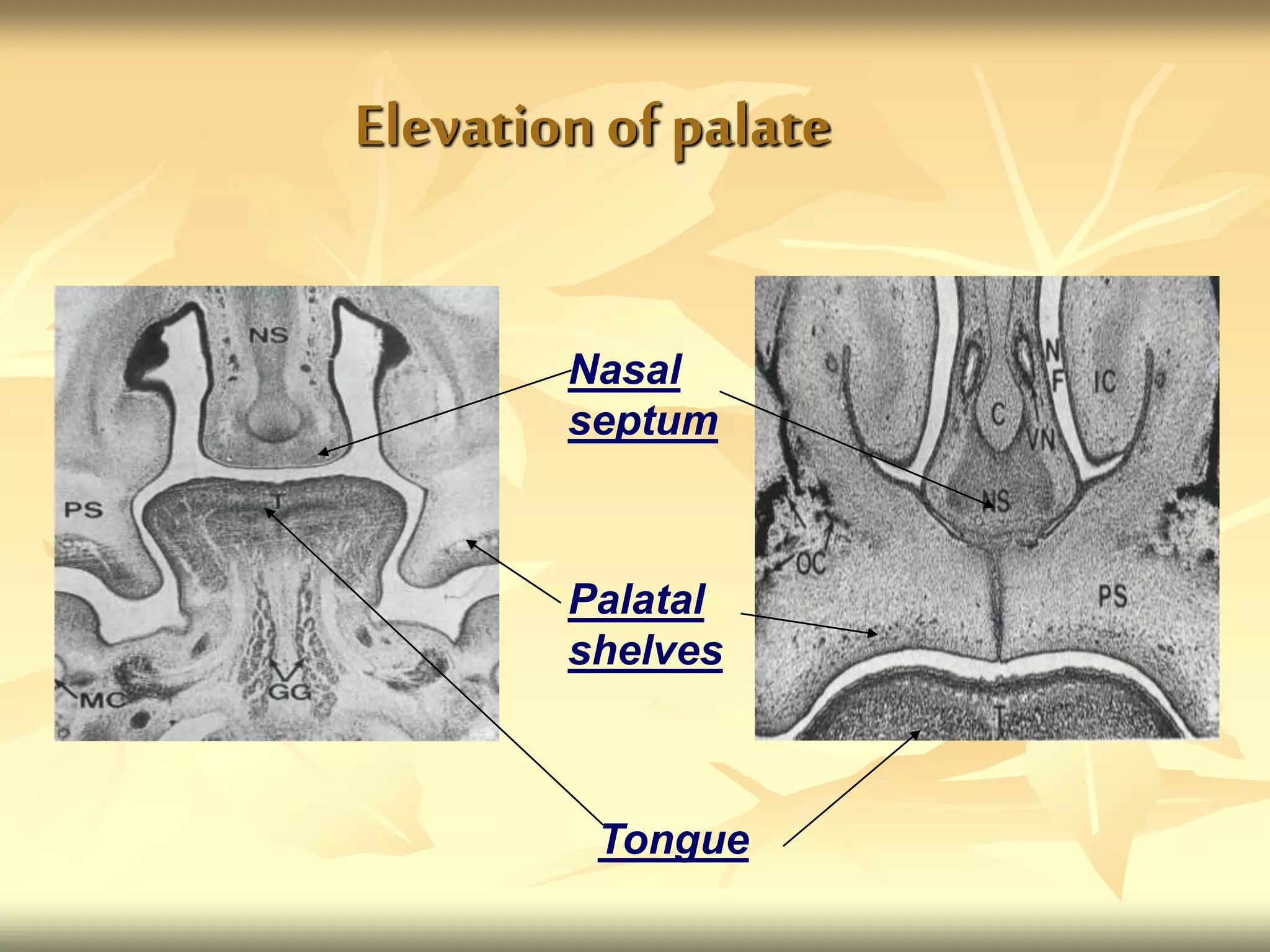 Elevation of palate
Nasal
septum
Palatal
shelves
Tongue
 