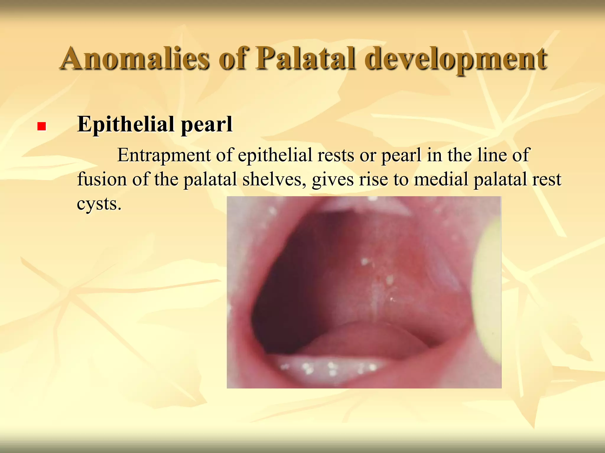 Anomalies of Palatal development
 Epithelial pearl
Entrapment of epithelial rests or pearl in the line of
fusion of the palatal shelves, gives rise to medial palatal rest
cysts.
 