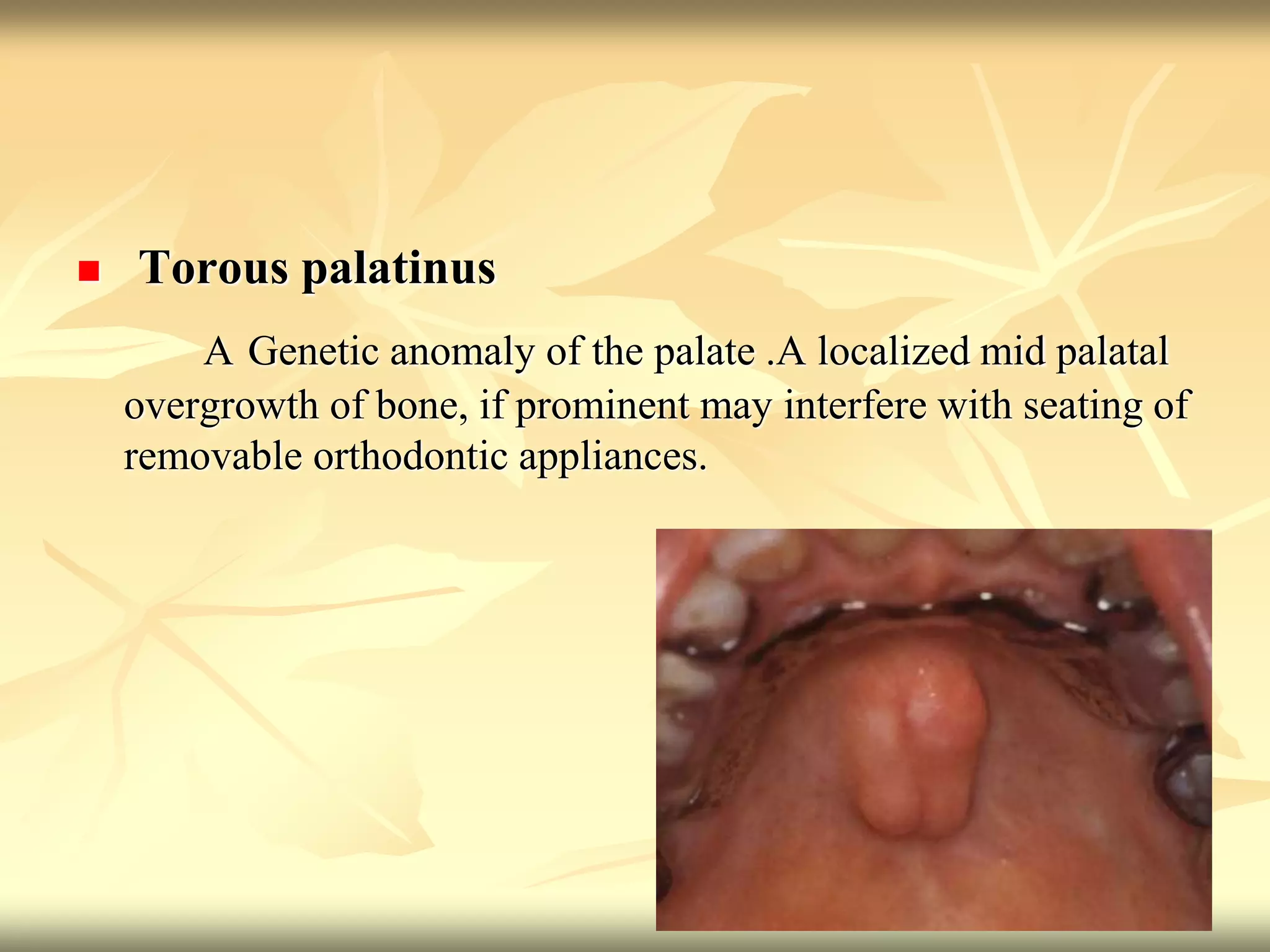  Torous palatinus
A Genetic anomaly of the palate .A localized mid palatal
overgrowth of bone, if prominent may interfere with seating of
removable orthodontic appliances.
 