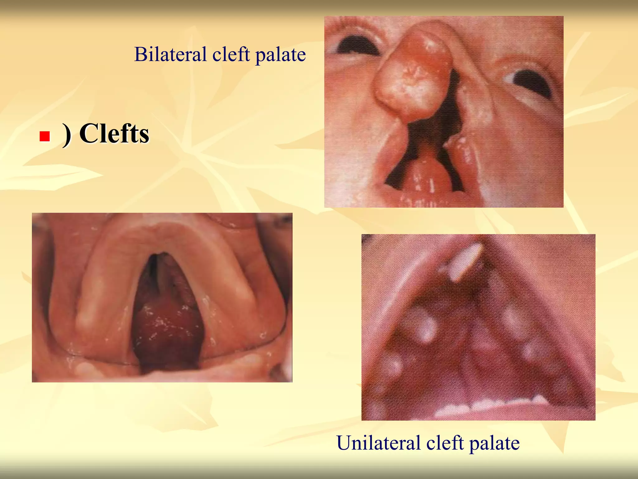  ) Clefts
Unilateral cleft palate
Bilateral cleft palate
 