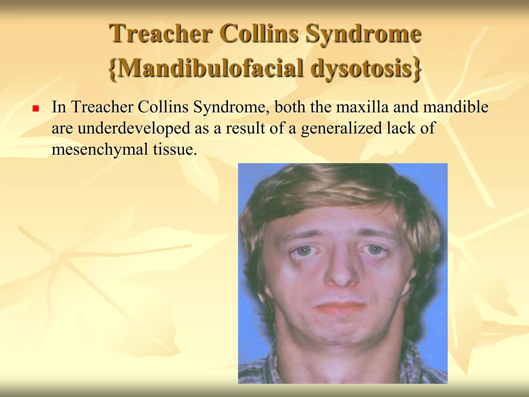 Treacher Collins Syndrome
{Mandibulofacial dysotosis}
 In Treacher Collins Syndrome, both the maxilla and mandible
are underdeveloped as a result of a generalized lack of
mesenchymal tissue.
 