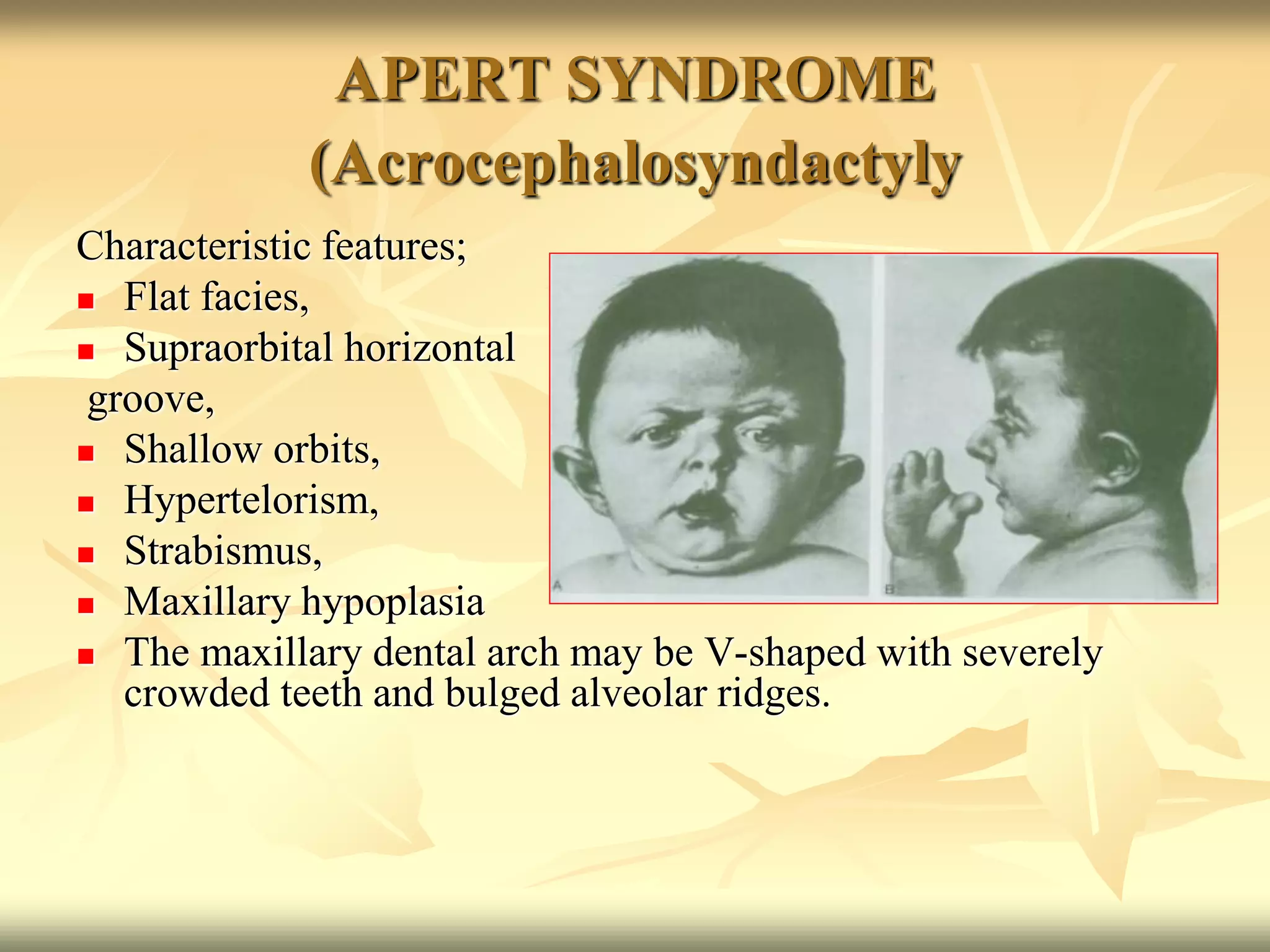 APERT SYNDROME
(Acrocephalosyndactyly
Characteristic features;
 Flat facies,
 Supraorbital horizontal
groove,
 Shallow orbits,
 Hypertelorism,
 Strabismus,
 Maxillary hypoplasia
 The maxillary dental arch may be V-shaped with severely
crowded teeth and bulged alveolar ridges.
 
