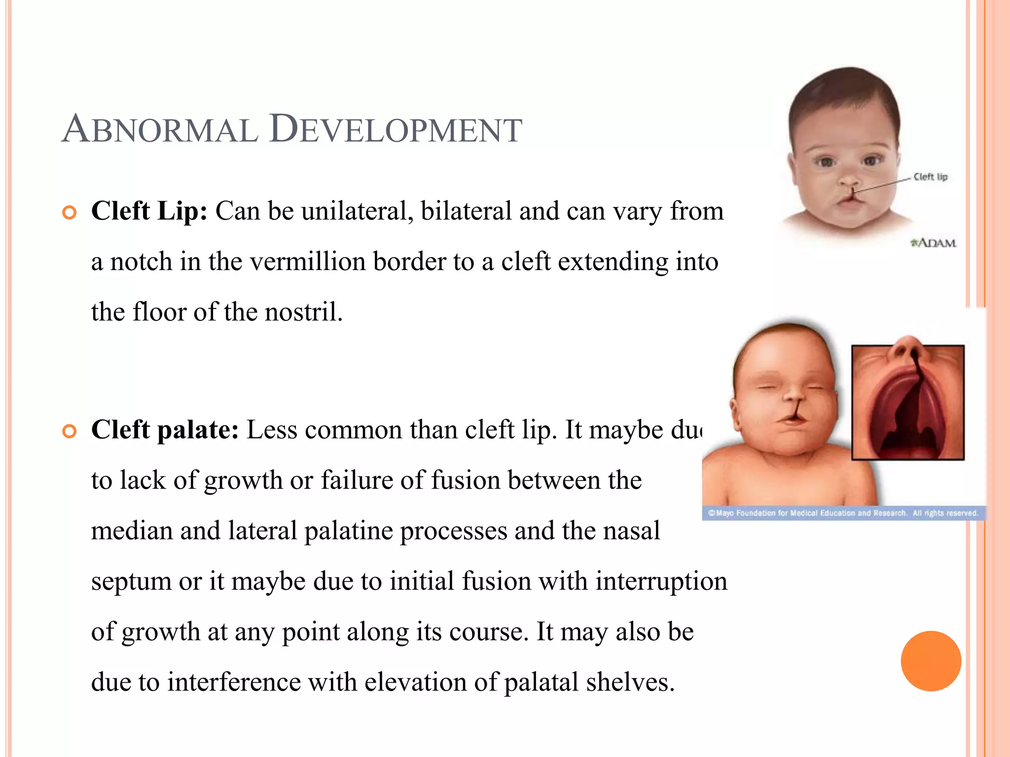 ABNORMAL DEVELOPMENT
   Cleft Lip: Can be unilateral, bilateral and can vary from
    a notch in the vermillion border to a cleft extending into
    the floor of the nostril.



   Cleft palate: Less common than cleft lip. It maybe due
    to lack of growth or failure of fusion between the
    median and lateral palatine processes and the nasal
    septum or it maybe due to initial fusion with interruption
    of growth at any point along its course. It may also be
    due to interference with elevation of palatal shelves.
 