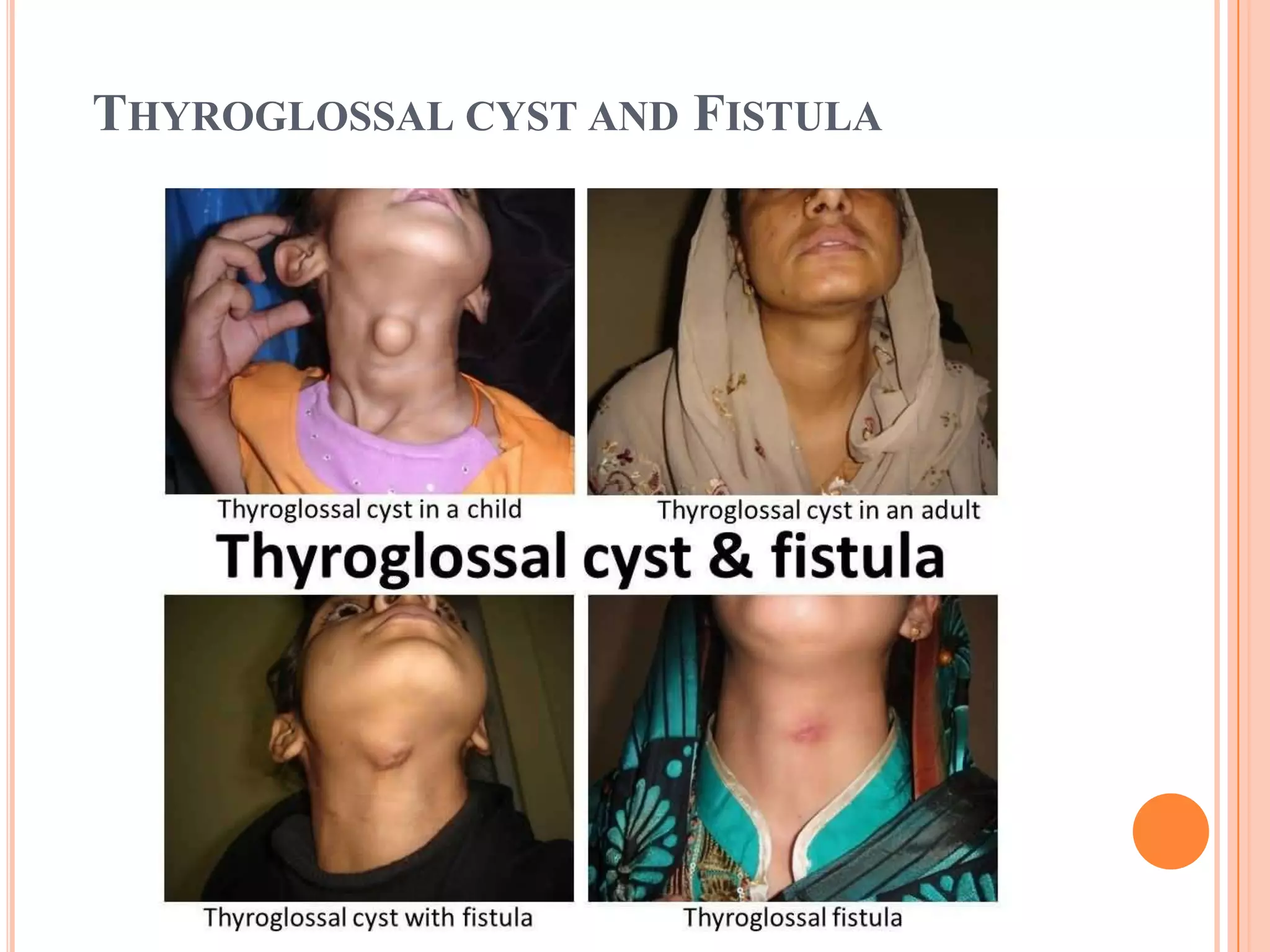 THYROGLOSSAL CYST AND FISTULA
 