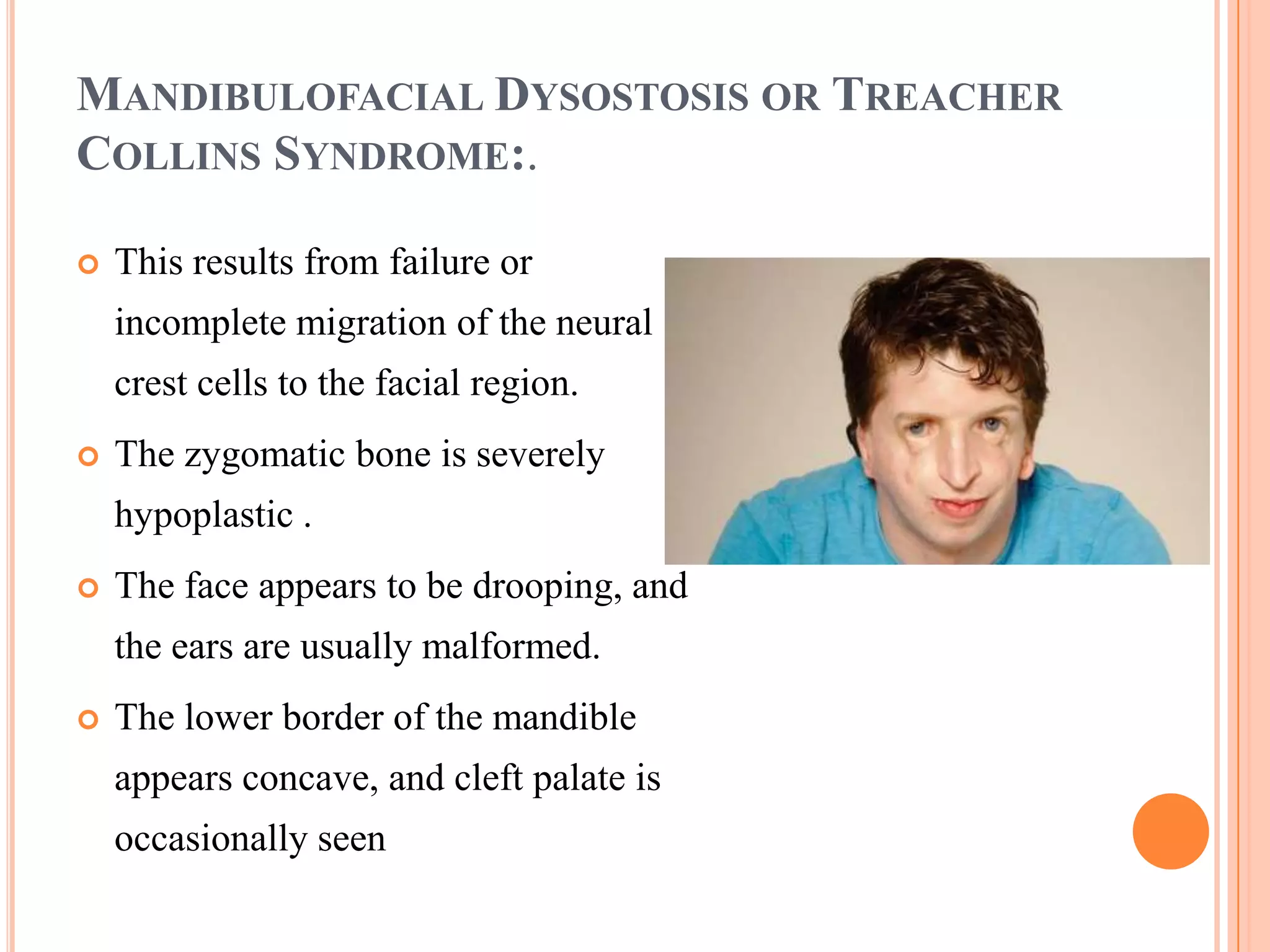 MANDIBULOFACIAL DYSOSTOSIS OR TREACHER
COLLINS SYNDROME:.

   This results from failure or
    incomplete migration of the neural
    crest cells to the facial region.
   The zygomatic bone is severely
    hypoplastic .
   The face appears to be drooping, and
    the ears are usually malformed.
   The lower border of the mandible
    appears concave, and cleft palate is
    occasionally seen
 