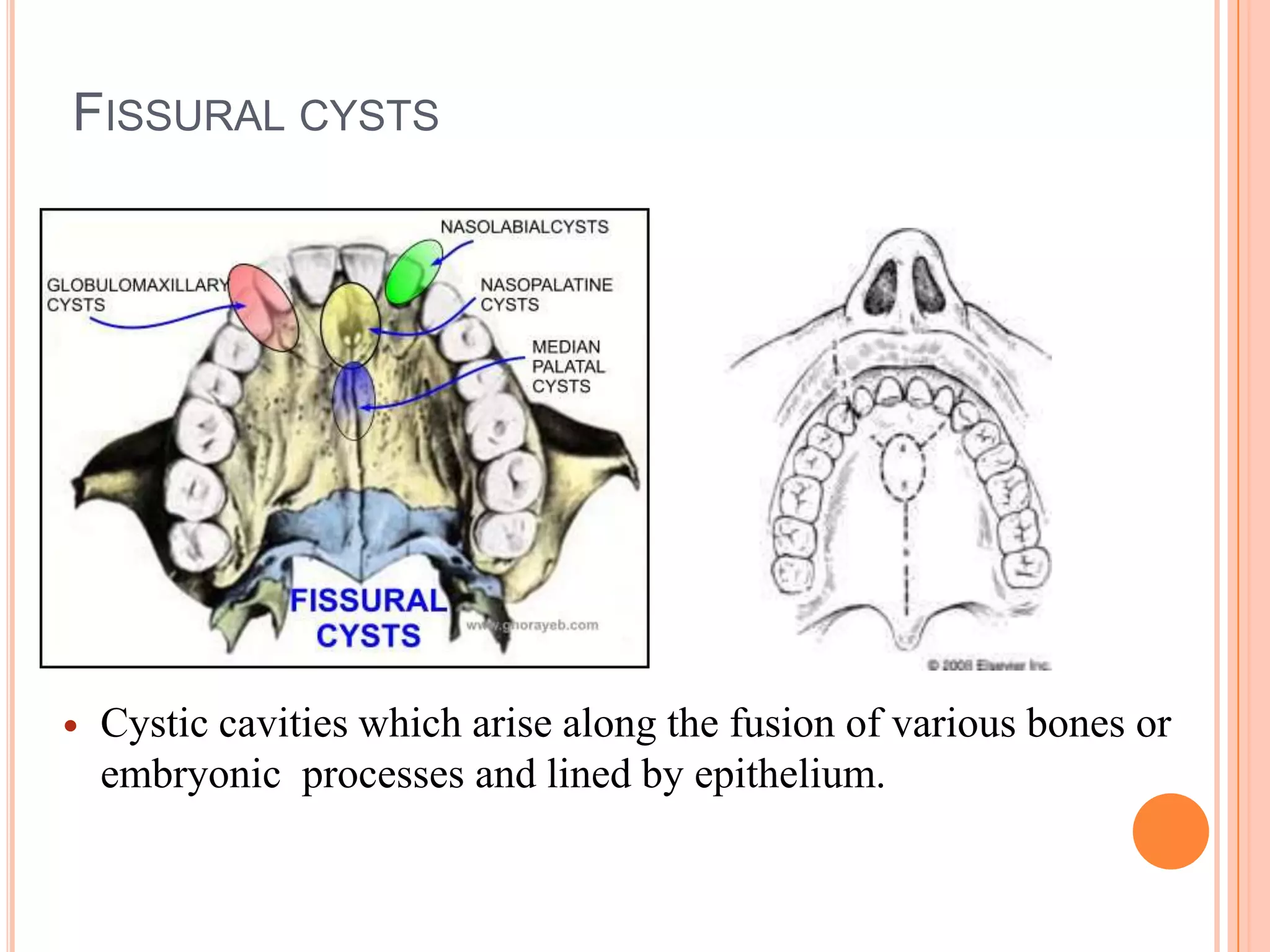 FISSURAL CYSTS




   Cystic cavities which arise along the fusion of various bones or
    embryonic processes and lined by epithelium.
 