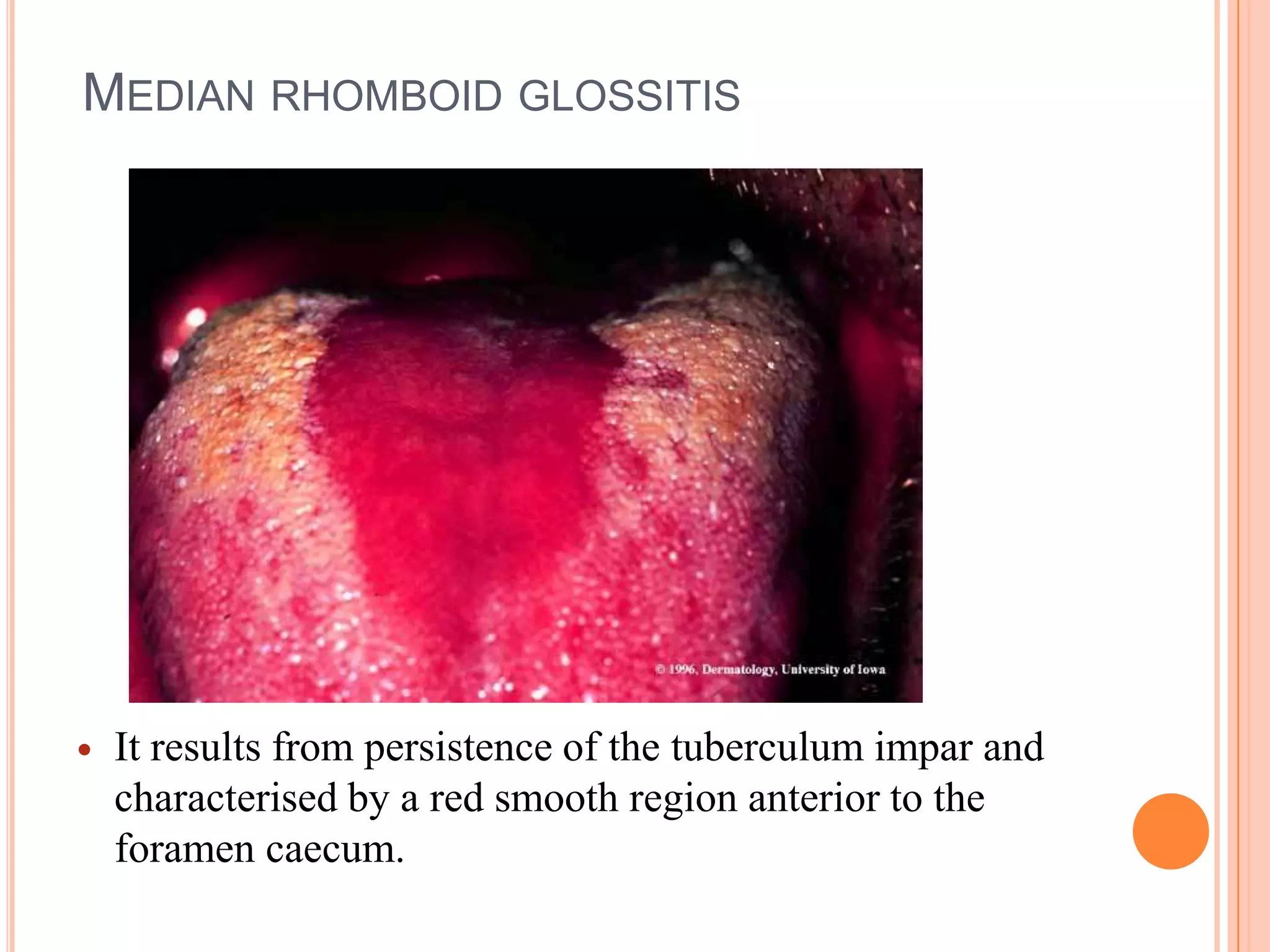MEDIAN RHOMBOID GLOSSITIS




   It results from persistence of the tuberculum impar and
    characterised by a red smooth region anterior to the
    foramen caecum.
 