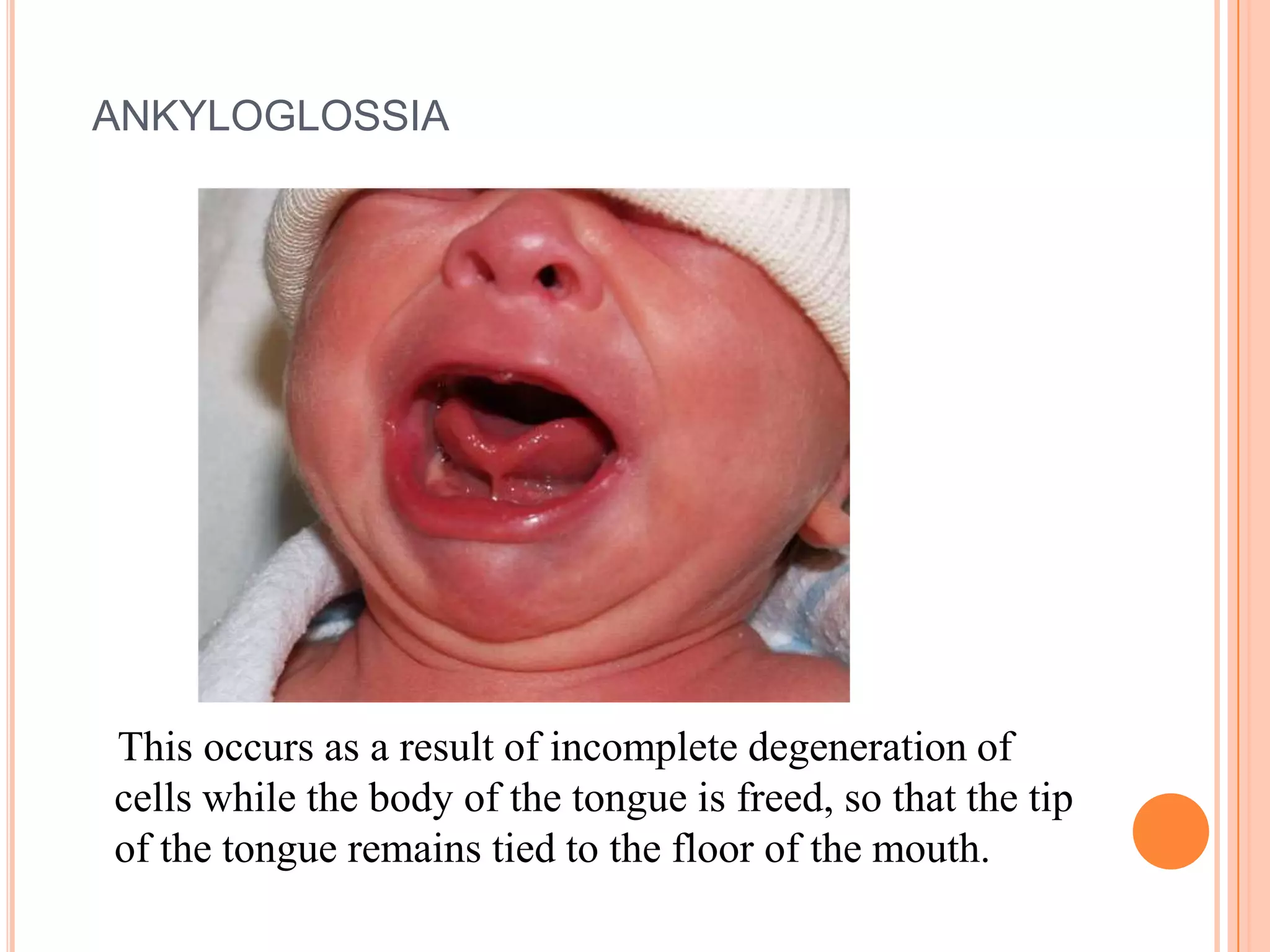 ANKYLOGLOSSIA




This occurs as a result of incomplete degeneration of
cells while the body of the tongue is freed, so that the tip
of the tongue remains tied to the floor of the mouth.
 