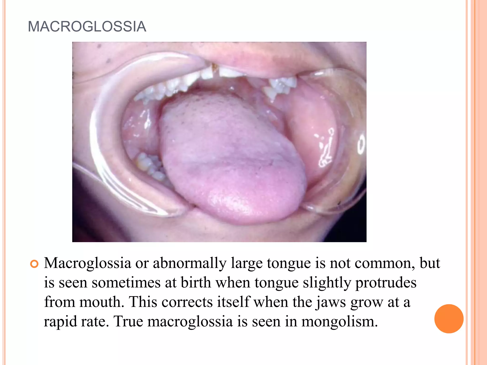 MACROGLOSSIA




   Macroglossia or abnormally large tongue is not common, but
    is seen sometimes at birth when tongue slightly protrudes
    from mouth. This corrects itself when the jaws grow at a
    rapid rate. True macroglossia is seen in mongolism.
 