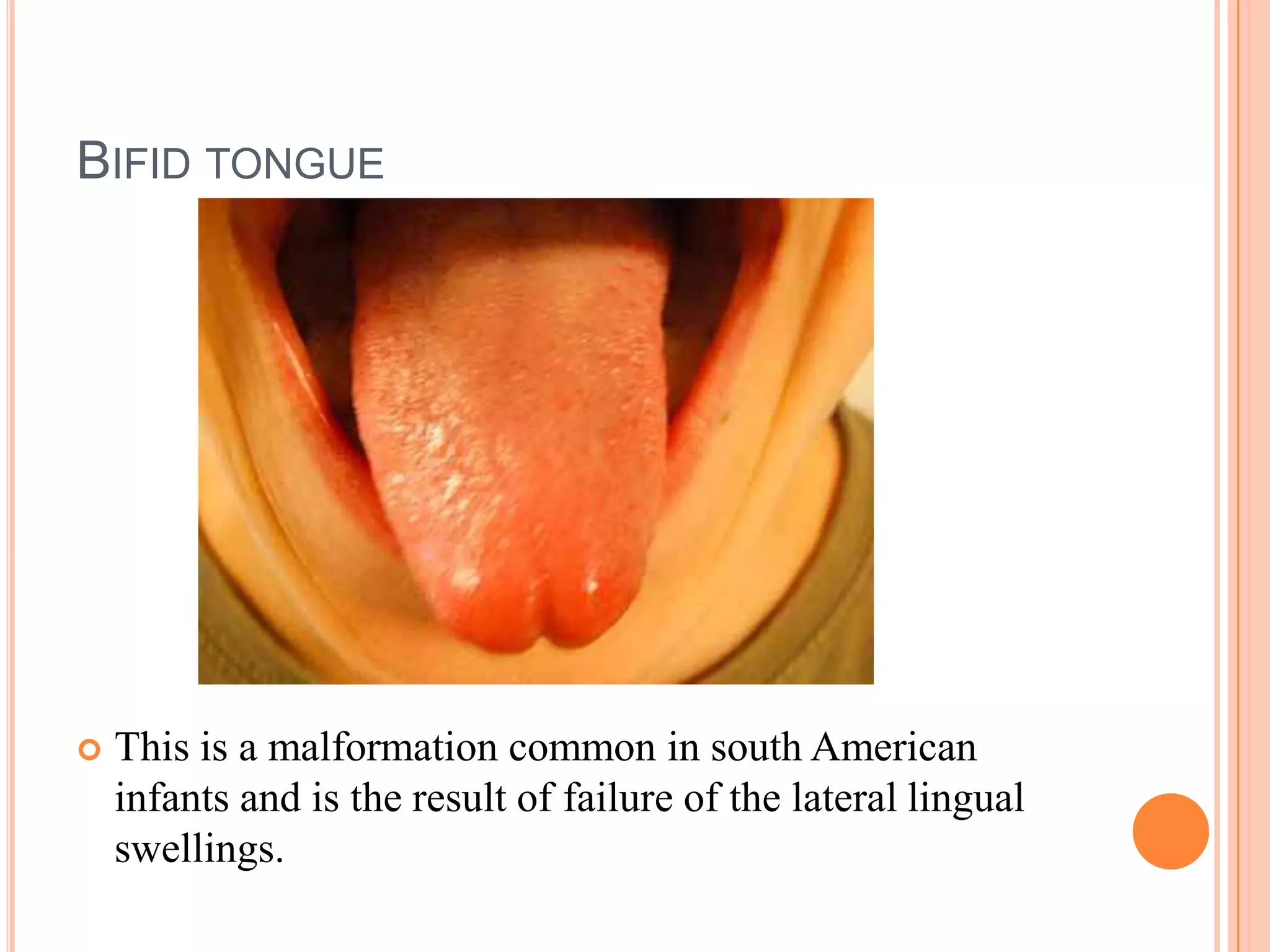 BIFID TONGUE




   This is a malformation common in south American
    infants and is the result of failure of the lateral lingual
    swellings.
 