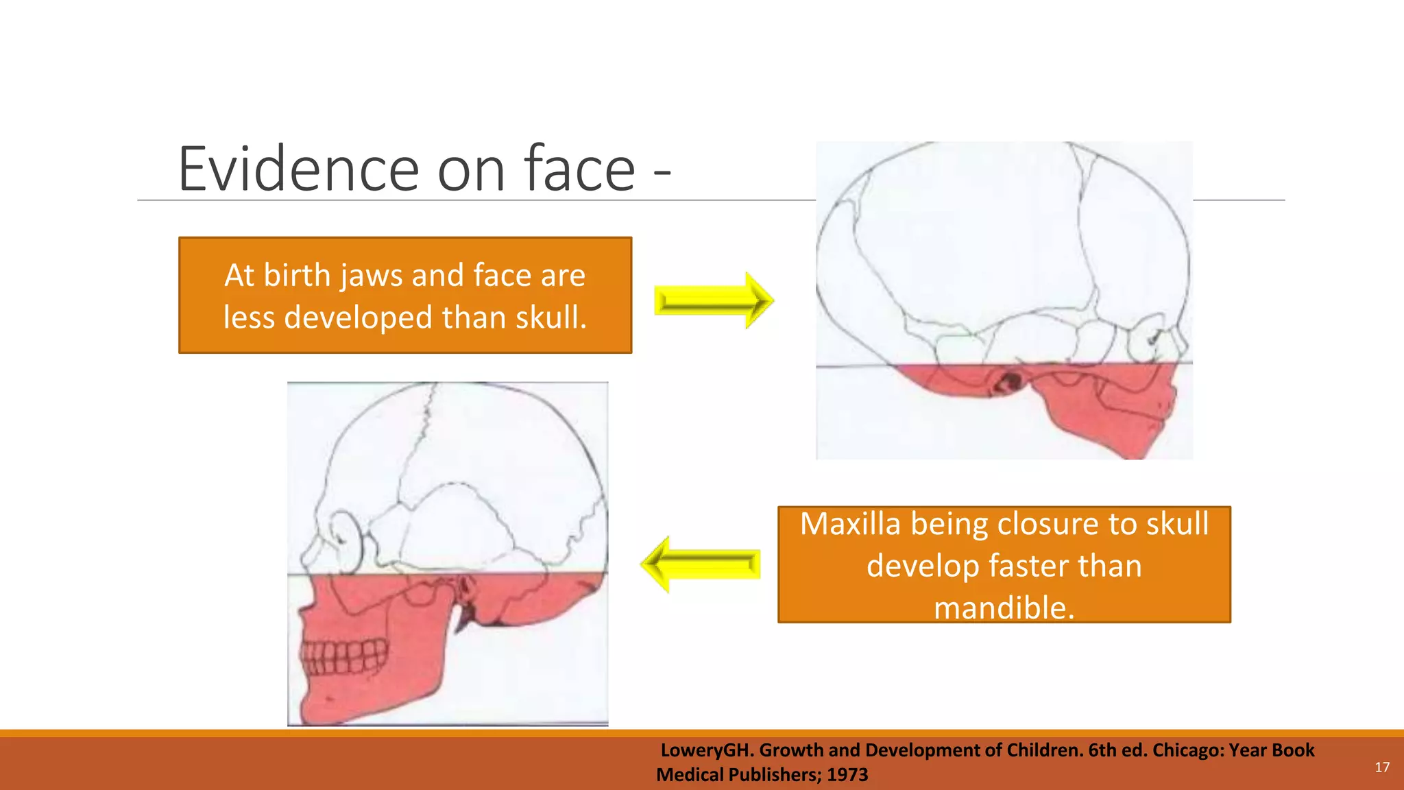 Evidence on face -
17
At birth jaws and face are
less developed than skull.
Maxilla being closure to skull
develop faster than
mandible.
LoweryGH. Growth and Development of Children. 6th ed. Chicago: Year Book
Medical Publishers; 1973
 