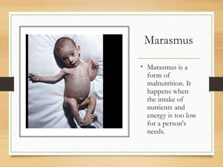 Marasmus
• Marasmus is a
form of
malnutrition. It
happens when
the intake of
nutrients and
energy is too low
for a person's
needs.
 
