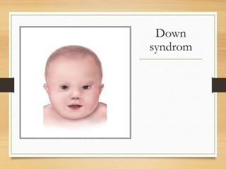 Down
syndrom
 