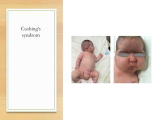 Cushing’s
syndrom
 