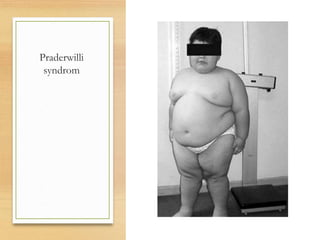 Praderwilli
syndrom
 