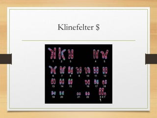 Klinefelter $
 