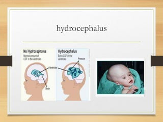 hydrocephalus
 