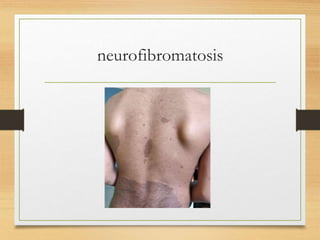 neurofibromatosis
 