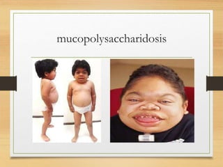 mucopolysaccharidosis
 