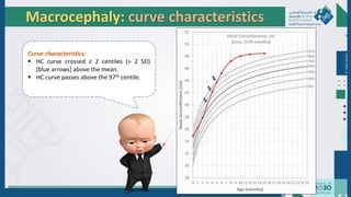 Dr.
Majdi
AlJasim
Macrocephaly: curve characteristics
Curve characteristics:
 HC curve crossed ≥ 2 centiles (> 2 SD)
[blue arrows] above the mean.
 HC curve passes above the 97th centile.
●
●
●
●
●
●
● ● ●
 