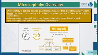 Dr.
Majdi
AlJasim
Microcephaly: Overview
Microcephaly is defined as head circumference greater than two standard deviations
below the mean (i.e. crossing ≥ 2 centiles) or lesser than the 3rd centile for a given
age and sex.
It is commonly congenital, but it can happen later with stunted head growth.
It is associated with brain development abnormalities.
 