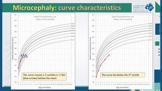 Dr.
Majdi
AlJasim
Microcephaly: curve characteristics
●
●
●
●
●
●
●
● ●
●
The curve lies below the 3rd centile
The curve crosses ≥ 2 centiles (> 2 SD)
[blue arrows] bellow the mean
 