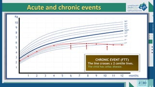 Dr.
Majdi
AlJasim
Acute and chronic events
98th
75th
50th
25th
2nd
1
2
3
4
5
6
7
8
9
10
Kg
1 2 3 4 5 6 7 8 9 10 11 12 months
10th
5th
90th
95th
●
●
●
●
● ● ● ● ● ●
CHRONIC EVENT (FTT)
The line crosses ≥ 2 centile lines.
The child has celiac disease.
 