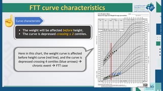 Dr.
Majdi
AlJasim
FTT curve characteristics
 The weight will be affected before height.
 The curve is depressed crossing ≥ 2 centiles.
Curve characteristic
Here in this chart, the weight curve is affected
before height curve (red line), and the curve is
depressed crossing 4 centiles (blue arrows) 
chronic event  FTT case
 