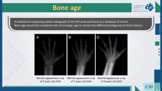 Dr.
Majdi
AlJasim
Bone age
A method of comparing a plain radiograph of the left wrist and hand to a database of norms.
Bone age should be compared with chronologic age to narrow the differential diagnosis of short stature.
Normal appearance x-ray
of 5 years old child
Normal appearance x-ray
of 7 years old child
Normal appearance x-ray
of 9 years old child
 