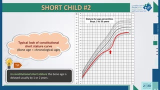 SHORT CHILD #2
Dr.
Majdi
AlJasim
Typical look of constitutional
short stature curve
(Bone age < chronological age)
In constitutional short stature the bone age is
delayed usually by 1 or 2 years.
TIP
 