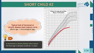 SHORT CHILD #2
Dr.
Majdi
AlJasim
Typical look of hormonal or
chronic disease short stature curve
(Bone age < chronological age)
In hormonal or chronic disease short stature
the bone age is delayed usually by > 2 years.
TIP
 
