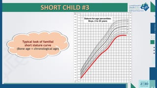 SHORT CHILD #3
Dr.
Majdi
AlJasim
Typical look of familial
short stature curve
(Bone age = chronological age)
 