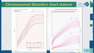 Dr.
Majdi
AlJasim
Chromosomal disorders short stature
 
