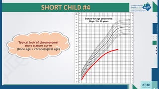 SHORT CHILD #4
Dr.
Majdi
AlJasim
Typical look of chromosomal
short stature curve
(Bone age = chronological age)
 