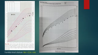 Familial short stature BA = CA > HA
 